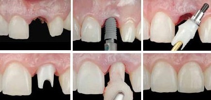 种植牙需要经过哪些修复过程?-做种植牙过程要